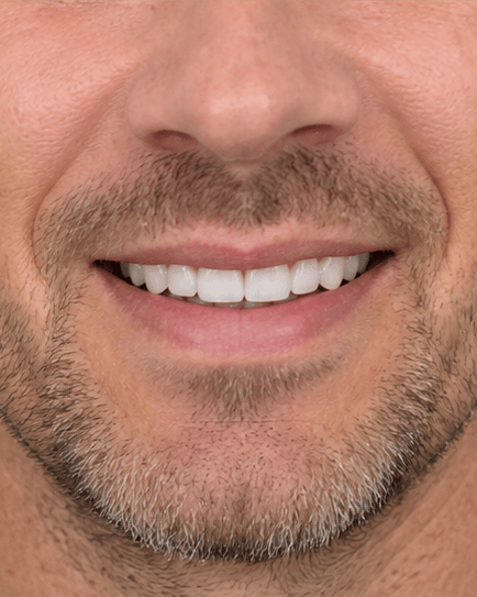 Veneers: after