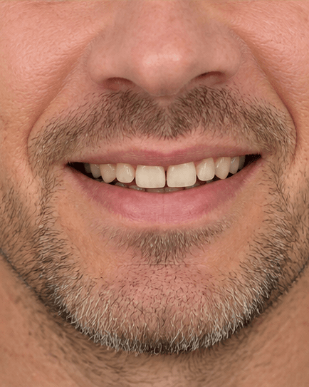 Veneers: before