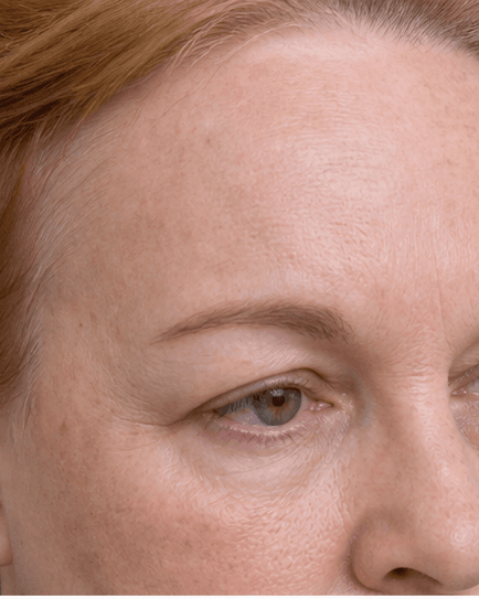 Chemical Brow Lift: before