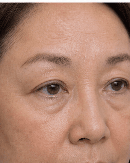 Chemical Brow Lift: after
