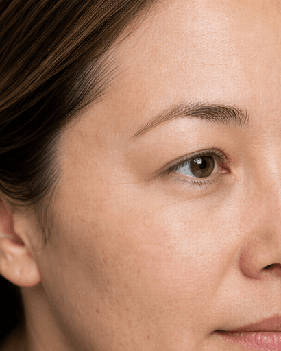 Crow's Feet Softening: after