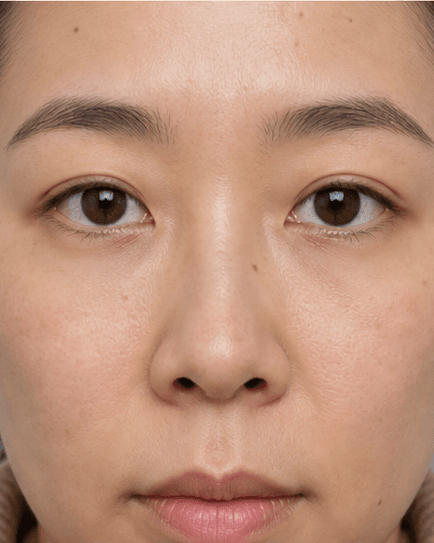 Eye Bag Evaluation: after