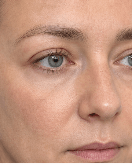 Under-Eye Brightening: after