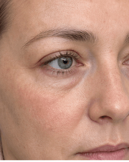 Under-Eye Brightening: before