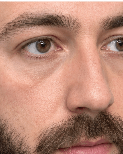 Under-Eye Brightening: after