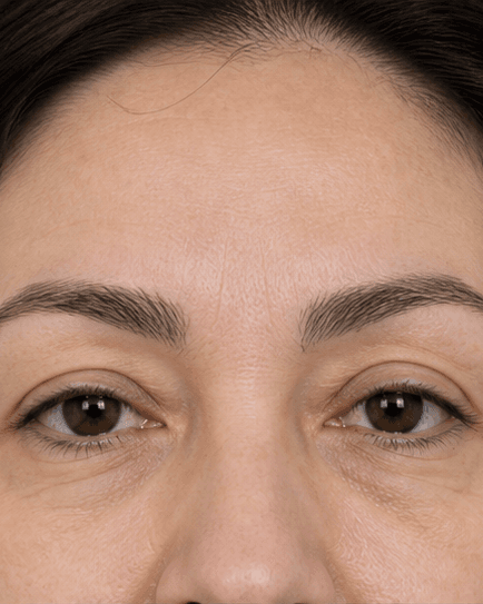 Brow Density Treatment: after