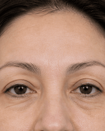 Brow Density Treatment: before