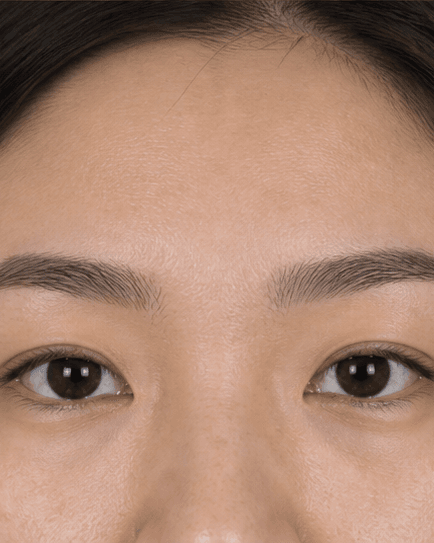 Brow Density Treatment: after