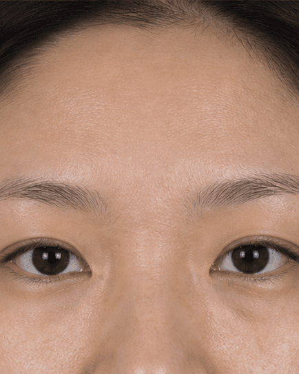 Brow Density Treatment: before
