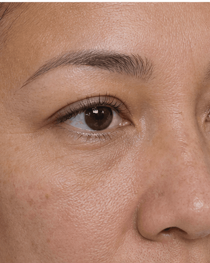 Lash Growth Therapy: after