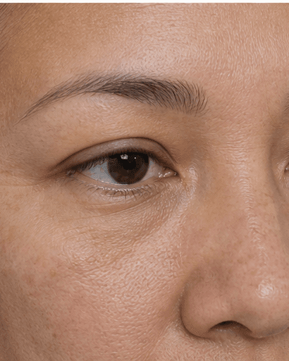 Lash Growth Therapy: before
