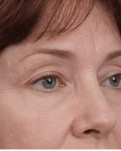 Eyelid Resurfacing: after