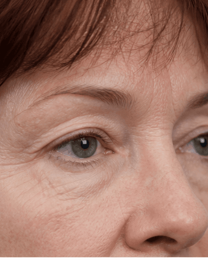 Eyelid Resurfacing: before