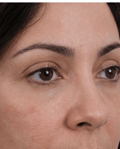 Eyelid Resurfacing: after