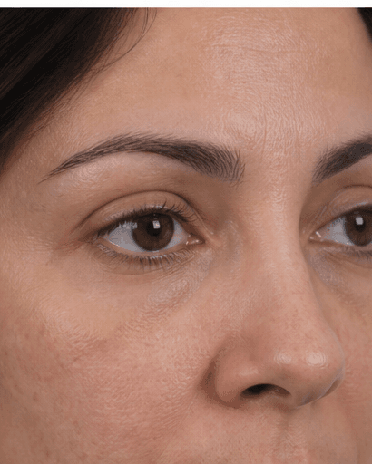 Eyelid Resurfacing: before