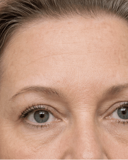 Non-Surgical Eyelid Tightening: after
