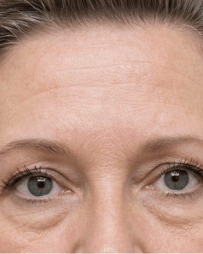 Non-Surgical Eyelid Tightening: before