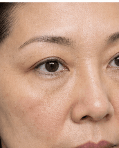 Non-Surgical Eyelid Tightening: after