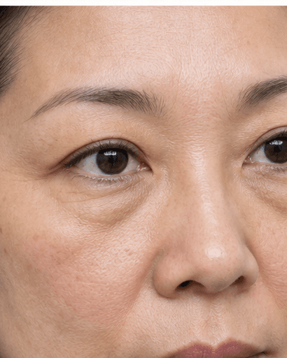 Non-Surgical Eyelid Tightening: before