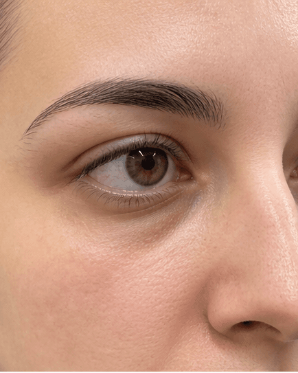 Milia Removal: after