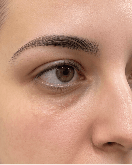Milia Removal: before