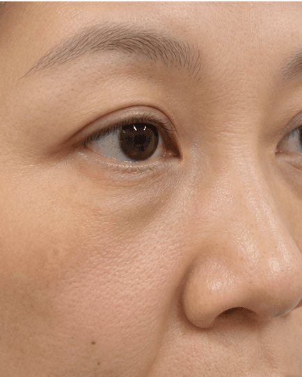 Milia Removal: after