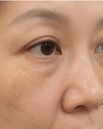 Milia Removal: before