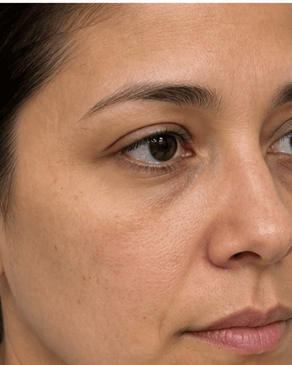 Tear Trough Correction: before