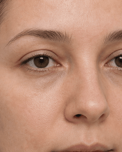 Under-Eye Mesotherapy: after