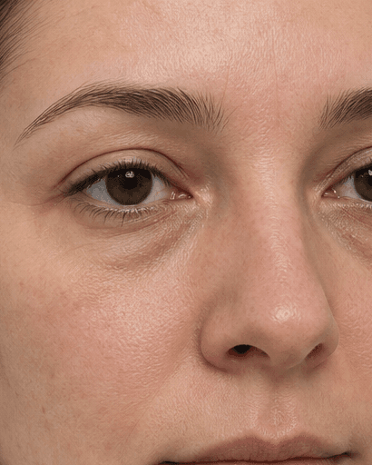 Under-Eye Mesotherapy: before