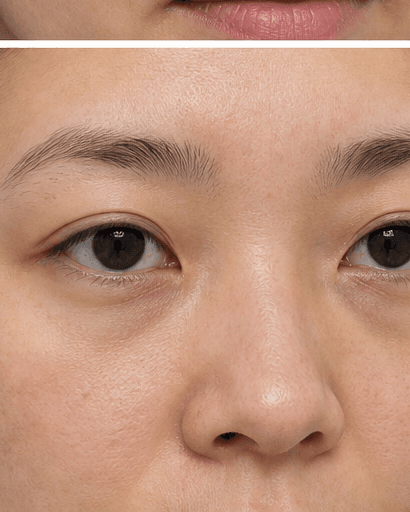 Under-Eye Mesotherapy: after