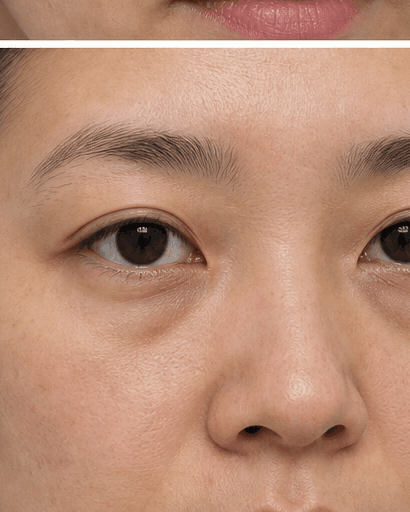 Under-Eye Mesotherapy: before