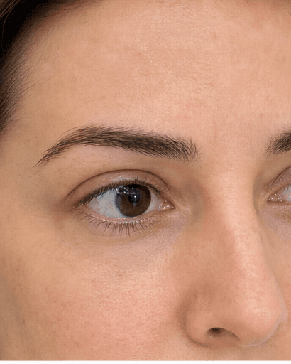 Under-Eye PRP: after