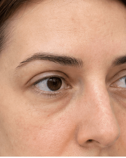 Under-Eye PRP: before