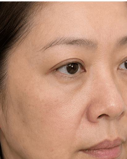 Under-Eye PRP: after