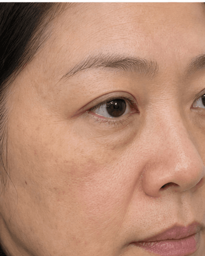 Under-Eye PRP: before