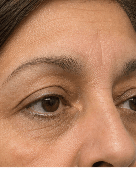 Xanthelasma Removal: after