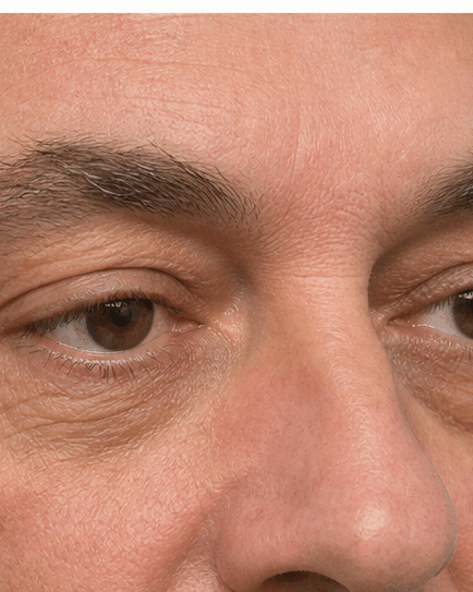 Xanthelasma Removal: after