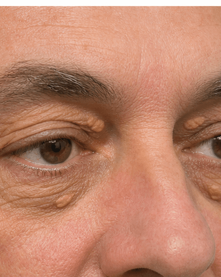 Xanthelasma Removal: before