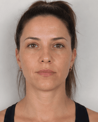 Facial Asymmetry Correction: after