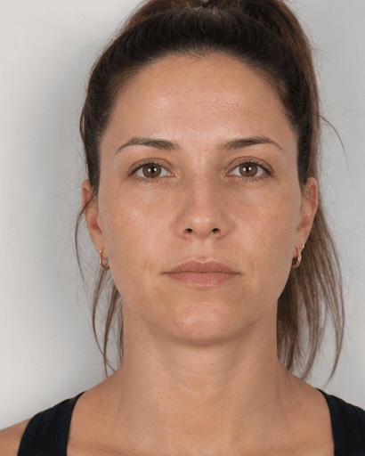 Facial Asymmetry Correction: before