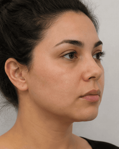 Buccal Fat Evaluation: after