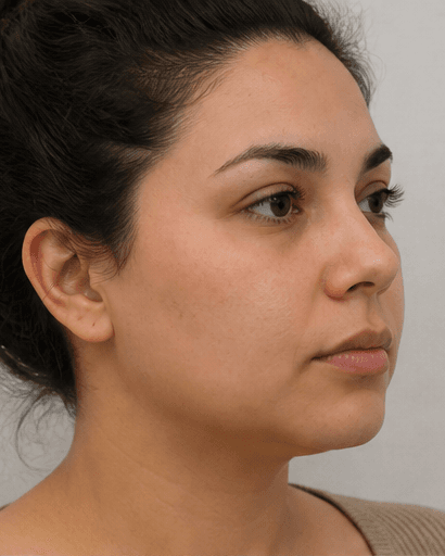 Buccal Fat Evaluation: before
