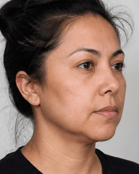 Buccal Slimming (Non-Surgical): after