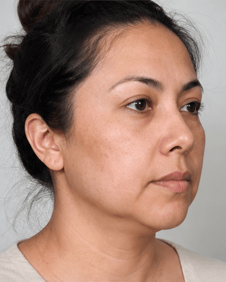 Buccal Slimming (Non-Surgical): before