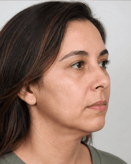 Buccal Slimming (Non-Surgical): after