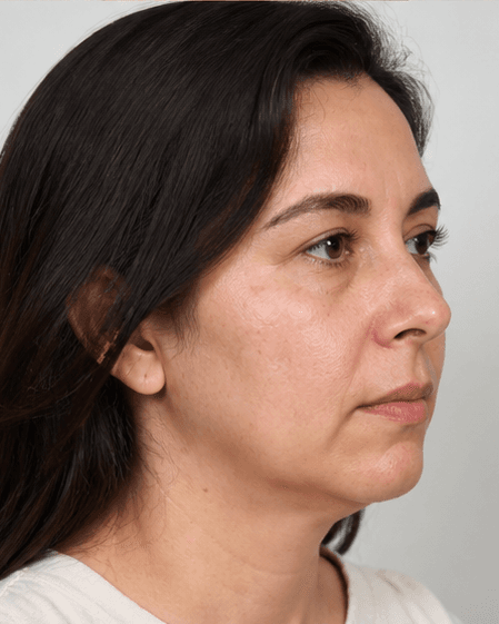 Buccal Slimming (Non-Surgical): before
