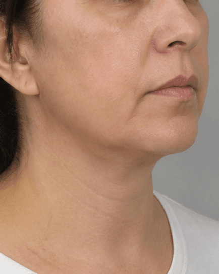 Submental Fat Dissolving: after