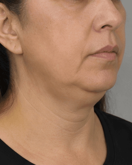 Submental Fat Dissolving: before