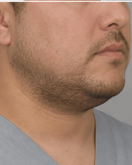 Submental Fat Dissolving: after